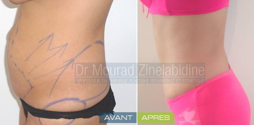 photo-avant-apres-abdominoplastie-tunisie-chirurgie-esthetique