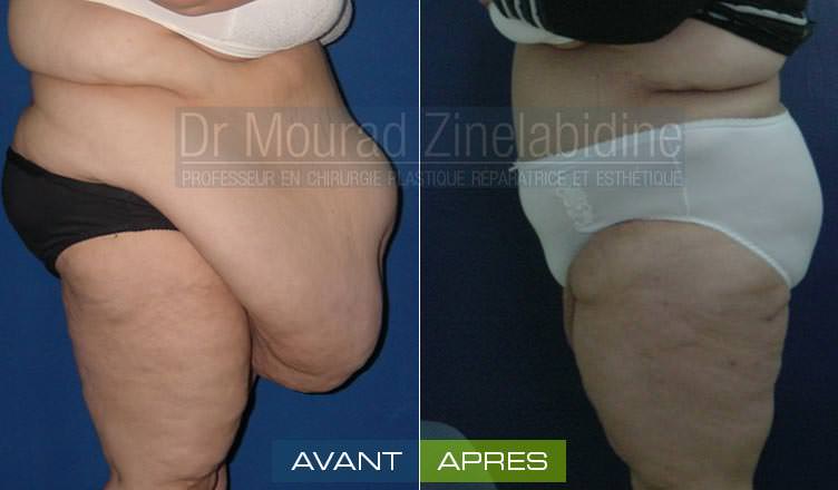 abdominoplastie-tunisie-photo-avant-apres-chirurgie-esthetique