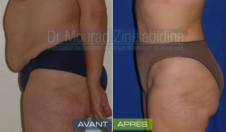abdominoplastie-tunisie-photo-avant-apres-chirurgie-esthetique