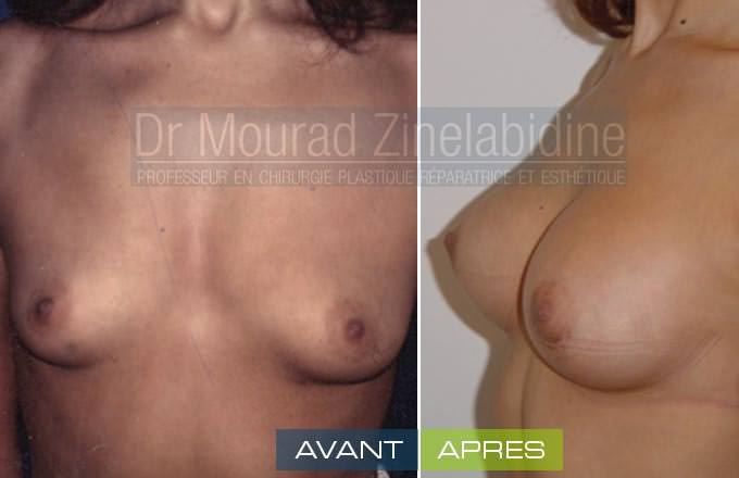 augmentation-mammaire-tunisie-photo-avant-apres-chirurgie-esthetique