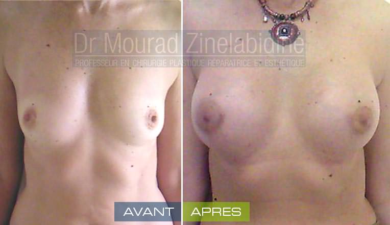 augmentation-mammaire-tunisie-photo-avant-apres-chirurgie-esthetique