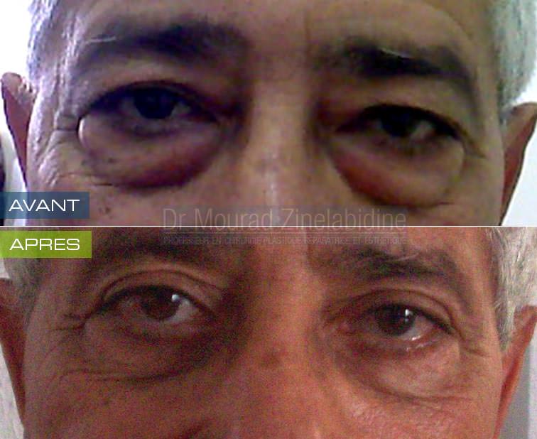 blepharoplastie-tunisie-photo-avant-apres-chirurgie-esthetique