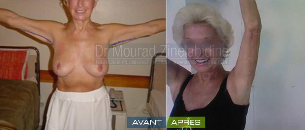 lifting-bras-tunisie-photo-avant-apres-chirurgie-esthetique