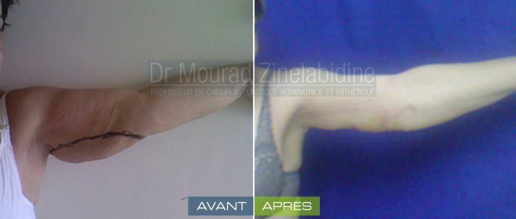lifting-bras-tunisie-photo-avant-apres-chirurgie-esthetique
