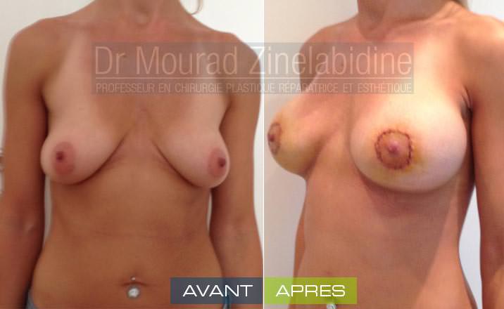 lifting-mammaire-tunisie-photo-avant-apres-chirurgie-esthetique