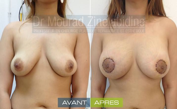 lifting-mammaire-tunisie-photo-avant-apres-chirurgie-esthetique