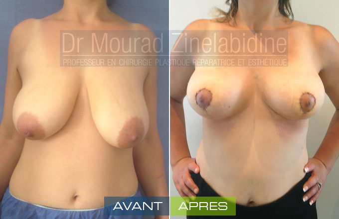 lifting-des-seins-tunisie-photo-avant-apres-chirurgie-esthetique