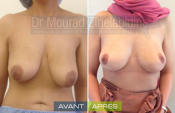 lifting-des-seins-tunisie-photo-avant-apres-chirurgie-esthetique