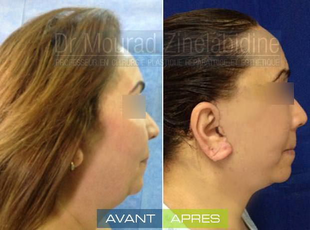 lifting-visage-tunisie-photo-avant-apres-chirurgie-esthetique