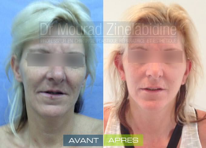 lifting-visage-tunisie-photo-avant-apres-chirurgie-esthetique