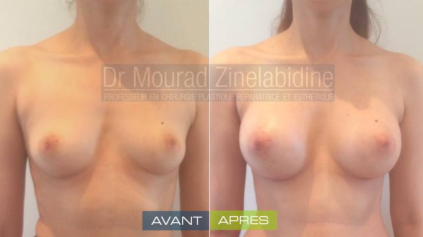lipofilling-mammaire-tunisie-photo-avant-apres-chirurgie-esthetique