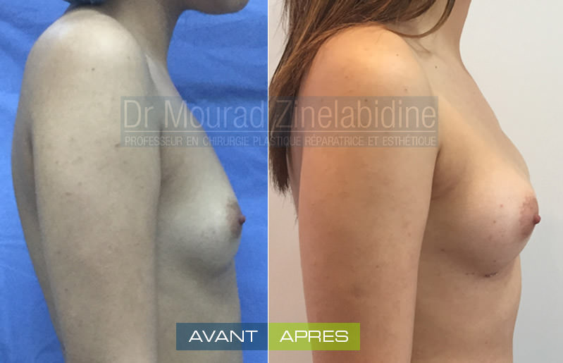 lipofilling-mammaire-tunisie-photo-avant-apres-chirurgie-esthetique