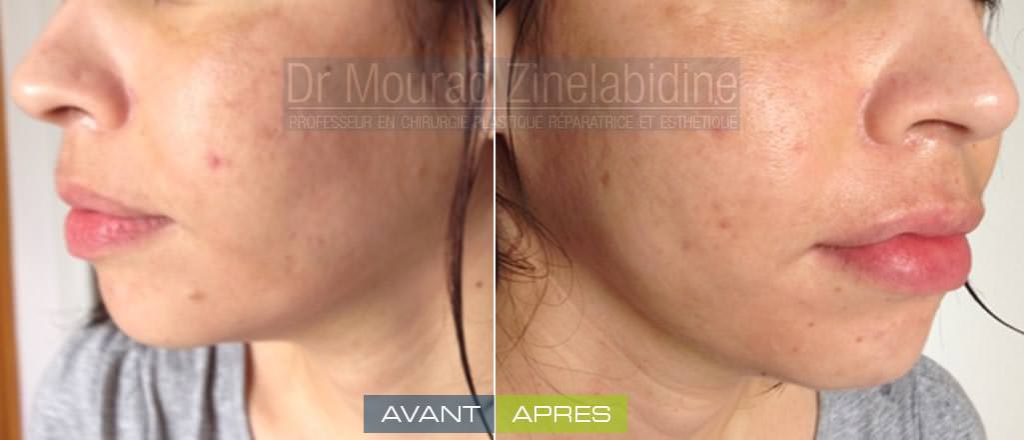 lipofilling-visage-tunisie-photo-avant-apres-chirurgie-esthetique