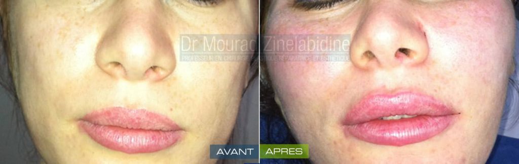 lipofilling-visage-tunisie-photo-avant-apres-chirurgie-esthetique