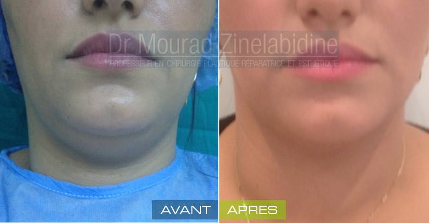 liposuccion-cou-tunisie-photo-avant-apres-chirurgie-esthetique