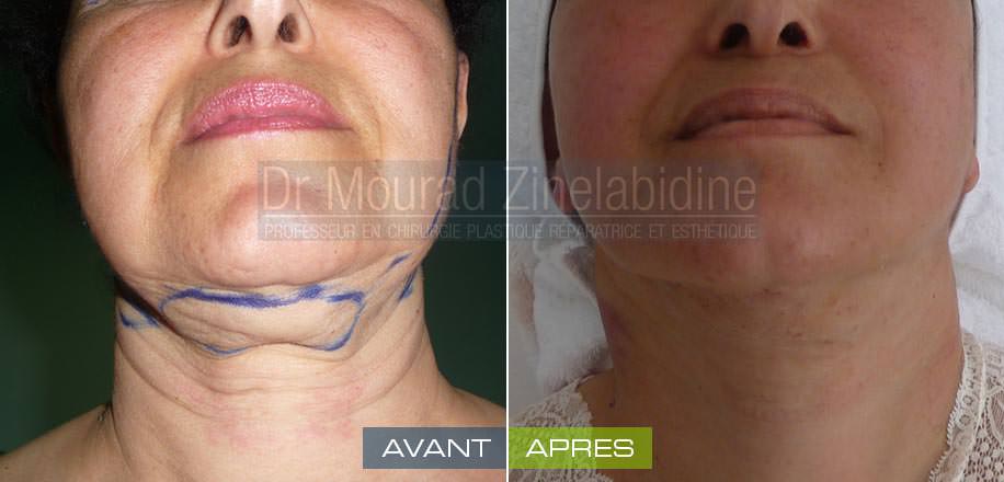 liposuccion-cou-tunisie-photo-avant-apres-chirurgie-esthetique