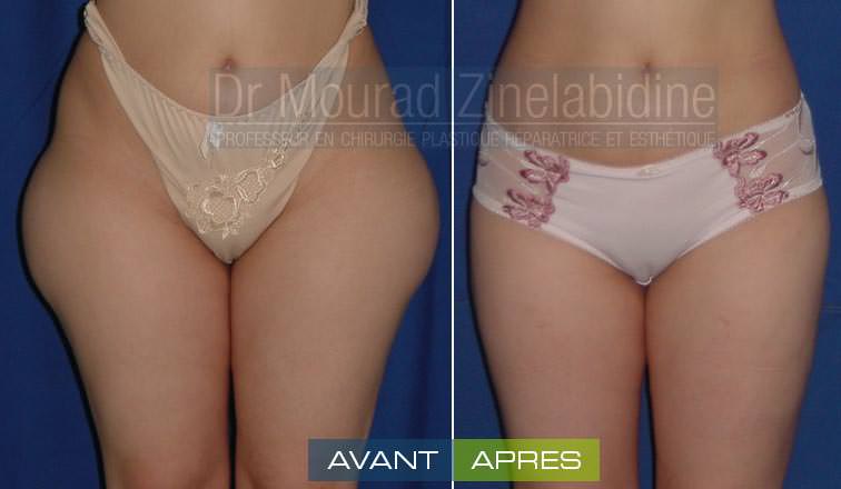 liposuccion-tunisie-photo-avant-apres-chirurgie-esthetique