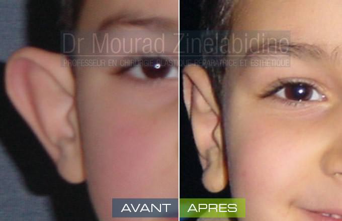 otoplastie-tunisie-photo-avant-apres-chirurgie-esthetique