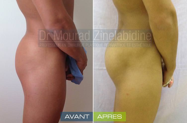augmentation-fesses-prothese-tunisie-avant-apres-chirurgie-esthetique