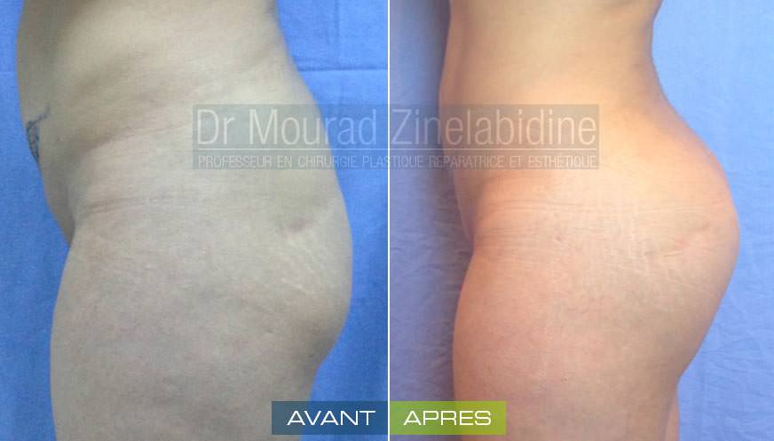 augmentation-fesses-prothese-tunisie-avant-apres-chirurgie-esthetique