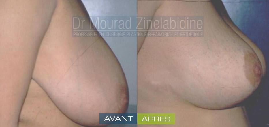 reduction-mammaire-tunisie-photo-avant-apres-chirurgie-esthetique
