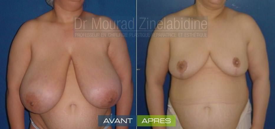 reduction-mammaire-tunisie-photo-avant-apres-chirurgie-esthetique
