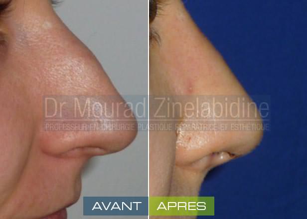 rhinoplastie tunisie-photo-avant-apres-chirurgie-esthetique