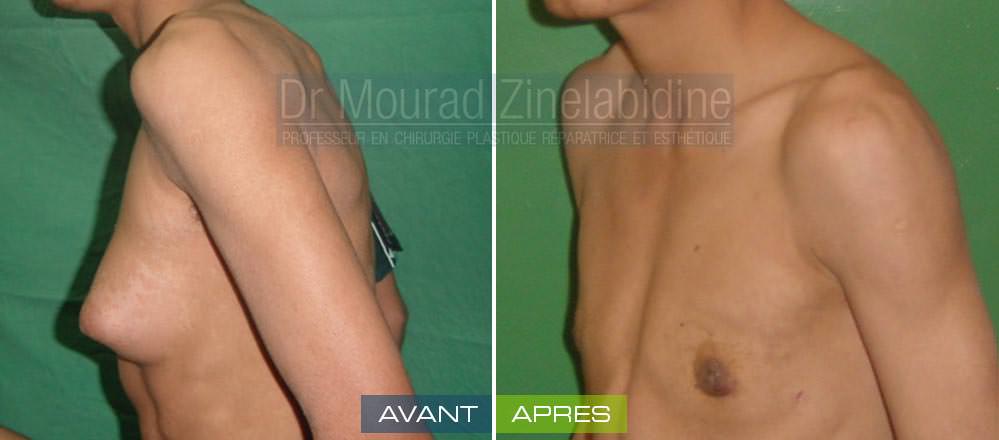 gynecomastie-tunisie-chirurgie-esthetique-avant-apres