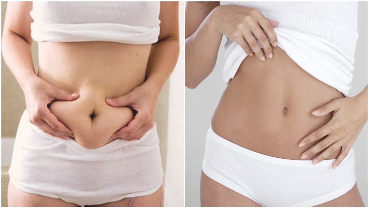 abdominoplastie-tunisie-chirurgie-ventre